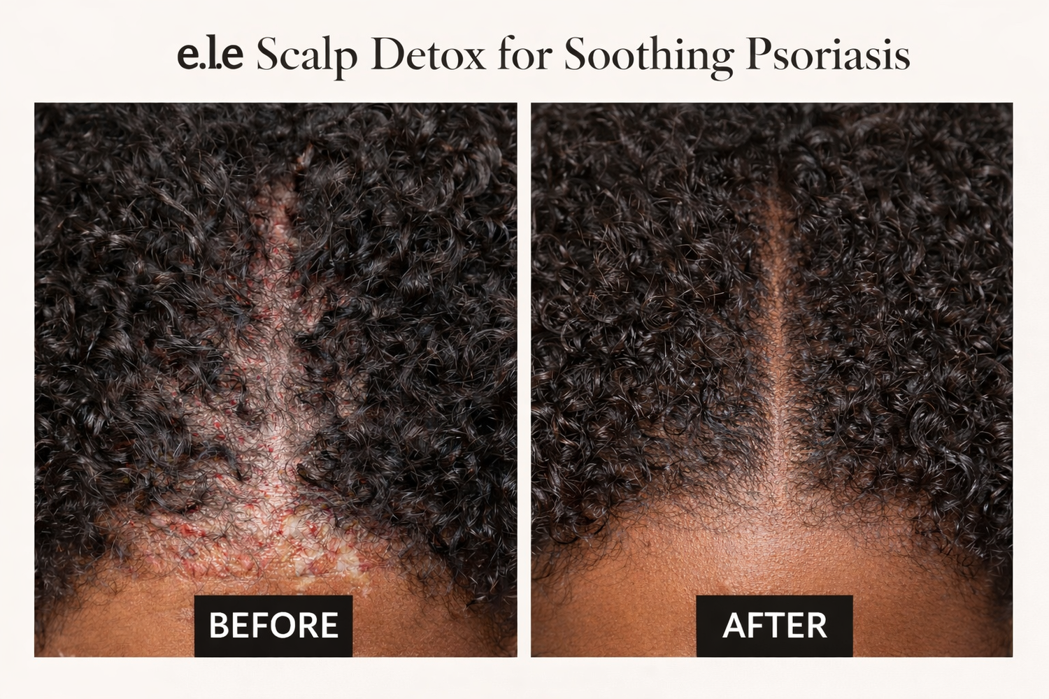 ￼ Itchy Scalp Products